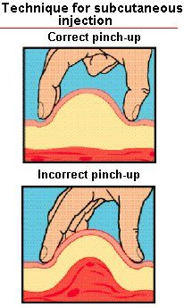 pinch-up_technique