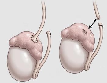 vasectomy-surgery